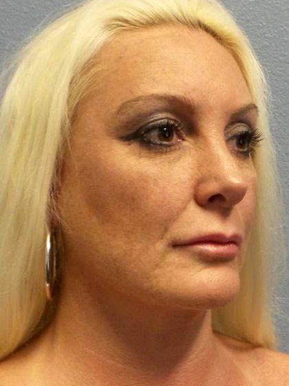 Rhinoplasty Before & After Patient #9770