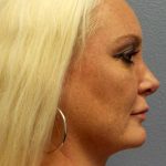 Rhinoplasty Before & After Patient #9770