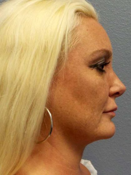 Rhinoplasty Before & After Patient #9770