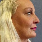Rhinoplasty Before & After Patient #9770