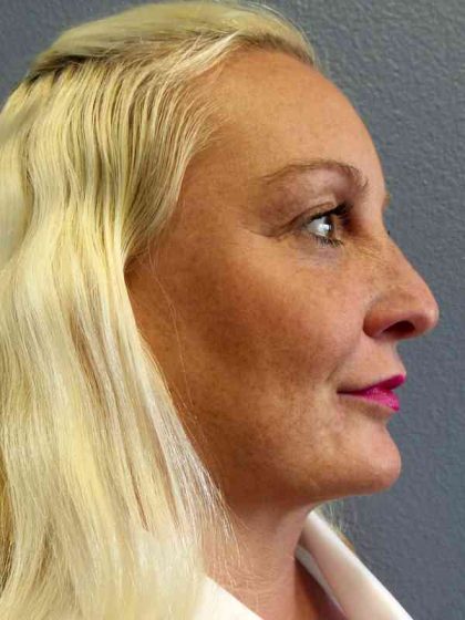 Rhinoplasty Before & After Patient #9770