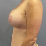 Breast Lift with Implant (Augmentation Mastopexy) Before & After Patient #4114