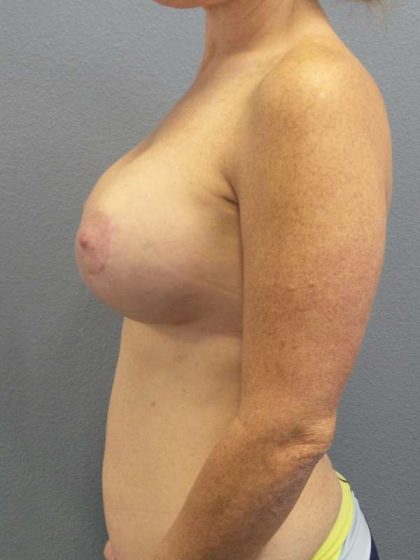 Breast Lift with Implant (Augmentation Mastopexy) Before & After Patient #4114