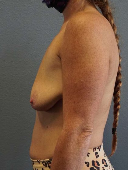 Breast Lift with Implant (Augmentation Mastopexy) Before & After Patient #4114