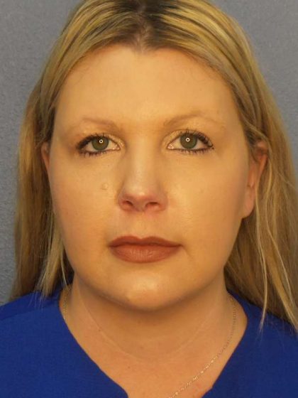 Liposuction of the Neck Before & After Patient #8010