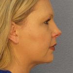 Liposuction of the Neck Before & After Patient #8010