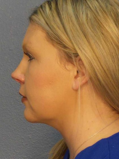 Liposuction of the Neck Before & After Patient #8010
