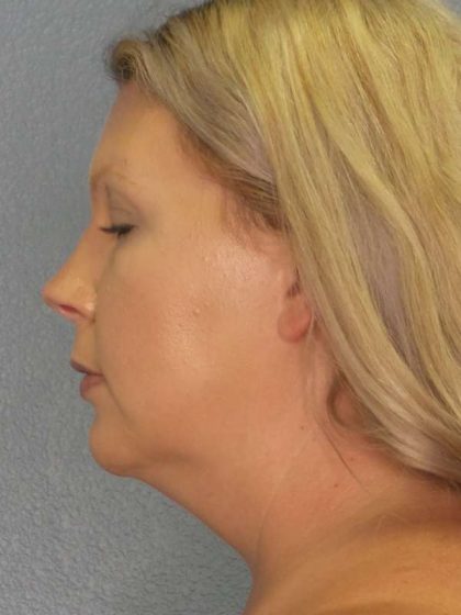 Liposuction of the Neck Before & After Patient #8010