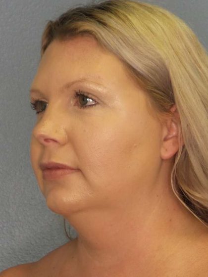 Liposuction of the Neck Before & After Patient #8010