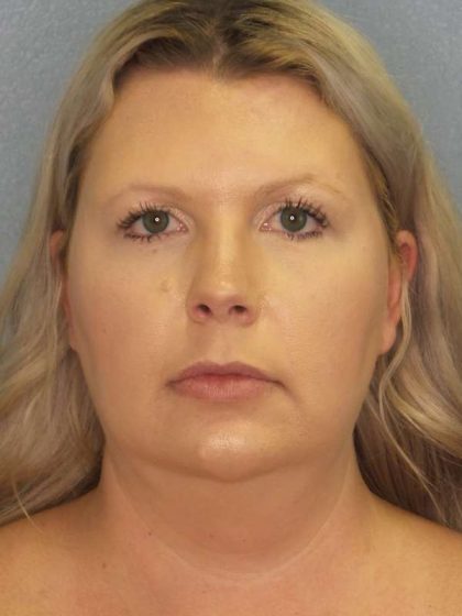 Liposuction of the Neck Before & After Patient #8010