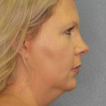 Liposuction of the Neck Before & After Patient #8010