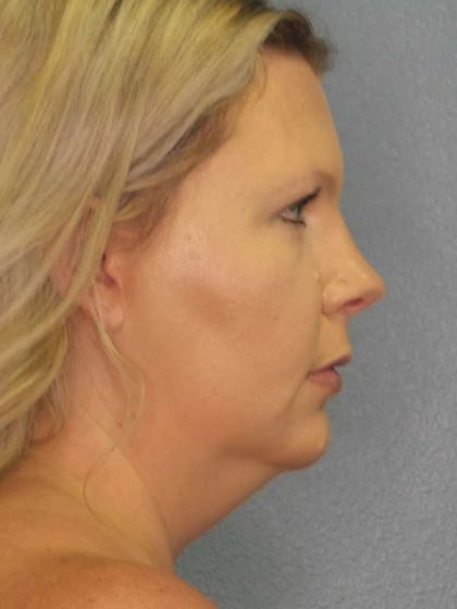 Liposuction of the Neck Before & After Patient #8010