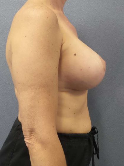Augmentation Mastopexy Revision Before & After Patient #4686