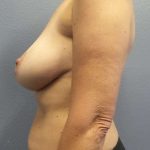 Augmentation Mastopexy Revision Before & After Patient #4686