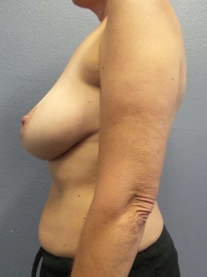Augmentation Mastopexy Revision Before & After Patient #4686
