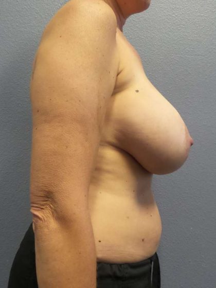 Augmentation Mastopexy Revision Before & After Patient #4686