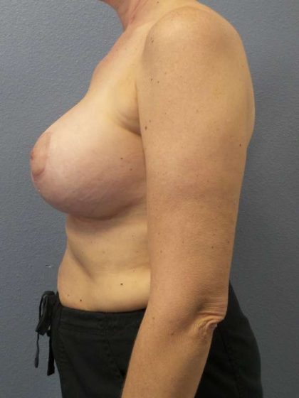 Augmentation Mastopexy Revision Before & After Patient #4686