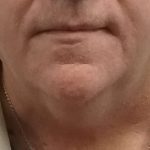 Liposuction of the Neck Before & After Patient #8350