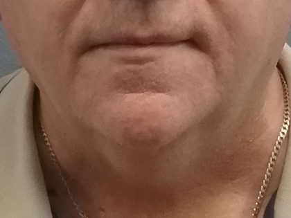 Liposuction of the Neck Before & After Patient #8350