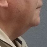 Liposuction of the Neck Before & After Patient #8350