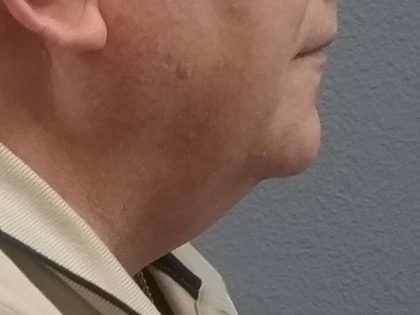 Liposuction of the Neck Before & After Patient #8350