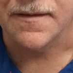 Liposuction of the Neck Before & After Patient #8350