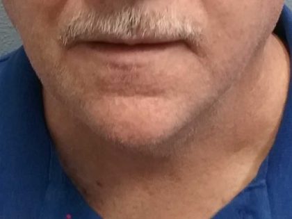 Liposuction of the Neck Before & After Patient #8350