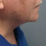 Liposuction of the Neck Before & After Patient #8350