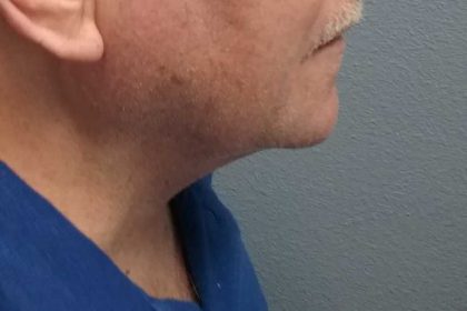 Liposuction of the Neck Before & After Patient #8350