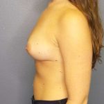 Breast Augmentation Before & After Patient #6053