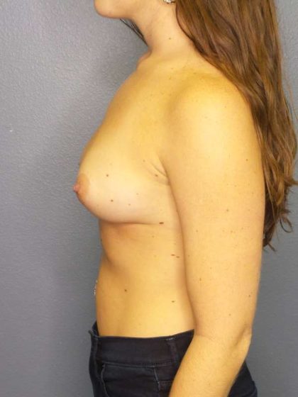 Breast Augmentation Before & After Patient #6053