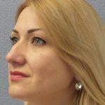 Rhinoplasty Before & After Patient #10197