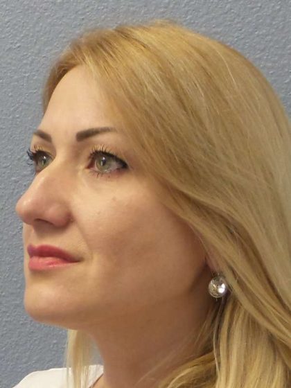 Rhinoplasty Before & After Patient #10197