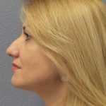 Rhinoplasty Before & After Patient #10197