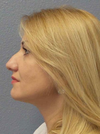 Rhinoplasty Before & After Patient #10197