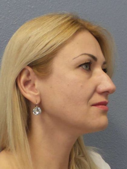 Rhinoplasty Before & After Patient #10197