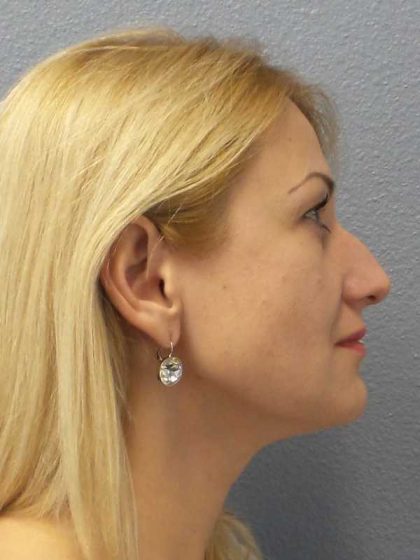 Rhinoplasty Before & After Patient #10197