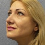 Rhinoplasty Before & After Patient #10197