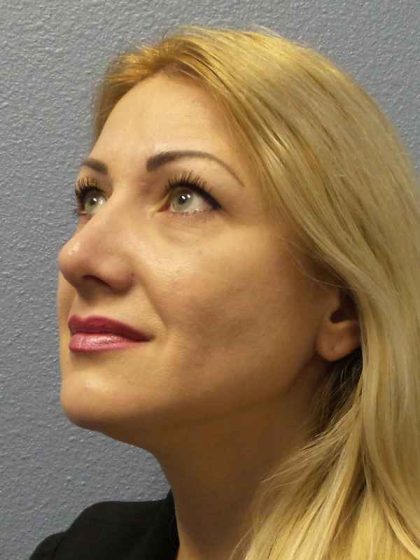 Rhinoplasty Before & After Patient #10197