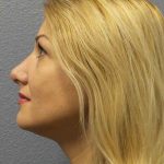 Rhinoplasty Before & After Patient #10197