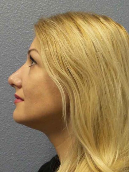 Rhinoplasty Before & After Patient #10197