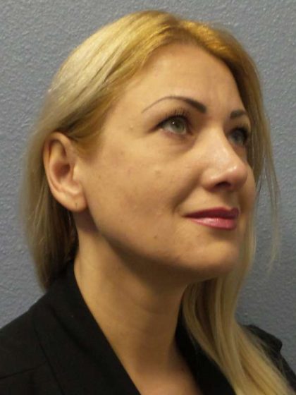 Rhinoplasty Before & After Patient #10197