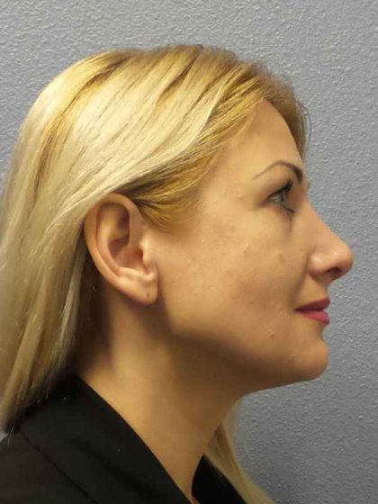 Rhinoplasty Before & After Patient #10197