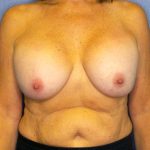 Augmentation Mastopexy Revision Before & After Patient #4628