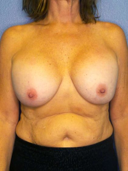 Augmentation Mastopexy Revision Before & After Patient #4628