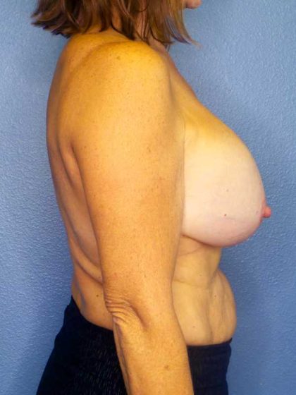 Augmentation Mastopexy Revision Before & After Patient #4628