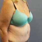 Abdominoplasty Before & After Patient #3539