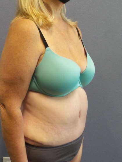 High BMI (Larger Patients) Surgery Before & After Patient #10367