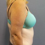 Abdominoplasty Before & After Patient #3539