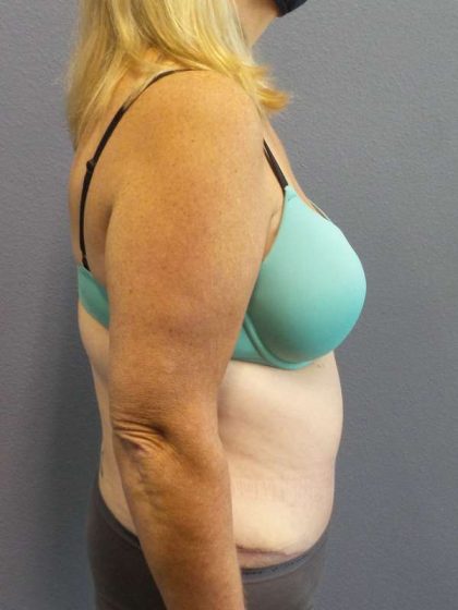 Abdominoplasty Before & After Patient #3539